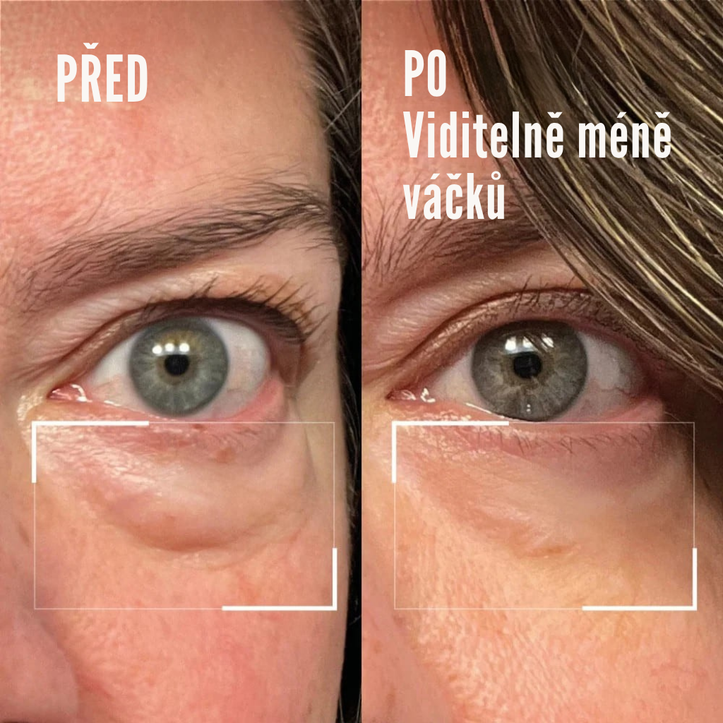 RedLift Eye